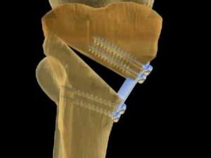 Ostéotomie: possibilités et résultats modernes
