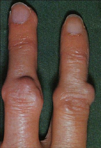 Rheumatoid nodules on fingers of a hand at a rheumatoid arthritis