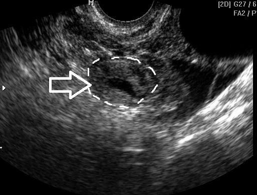 Negimdinis nėštumas ultragarsu