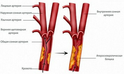 Non-stenotic atherosclerosis of BCA (brachiocephalic arteries)