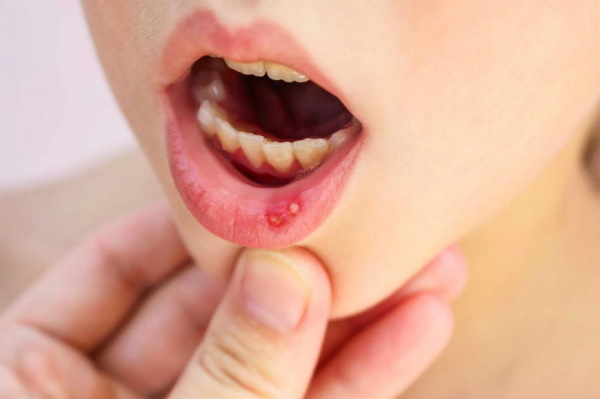 Chickenpox in the mouth. Photo, temperature, how long it takes, treatment