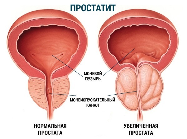 Behandeling van prostatitis met gember