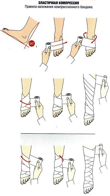 Bandaging the legs with an elastic bandage after surgery, with varicose veins, thrombosis, edema