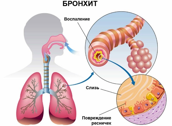 Znakovi bronhitisa u odrasle osobe bez temperature s kašljem, ispljuvakom i bez