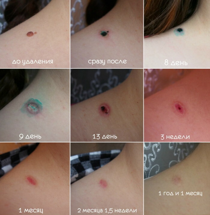 Removal of moles with a laser. Price, reviews