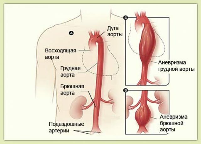 aneuryzma