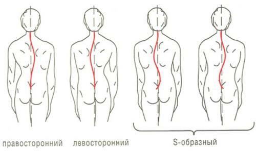 S-shaped Scoliosis Scheme