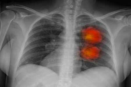 Schemi di trattamento del cancro del polmone
