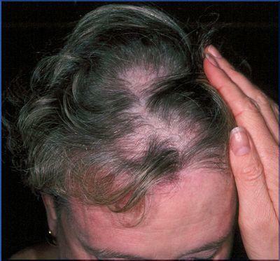 Difuzinė alopecija