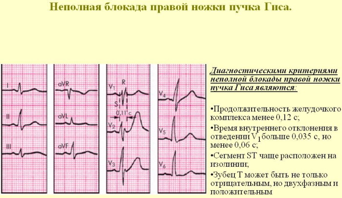 P -laine (R) EKG -l. Mis peegeldab, iseloomustab, normi