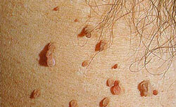 Intimate warts, warts in intimate places - treatment, causes, symptoms, photo