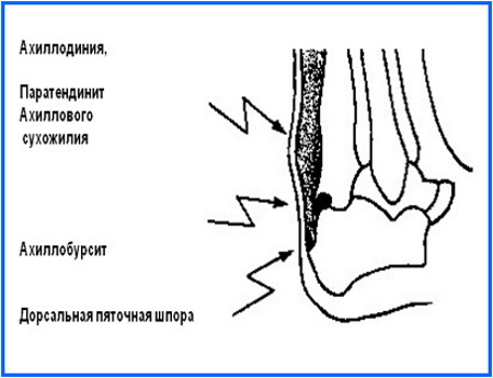 Achilles (Achilles) tendon. Where is on the leg, photo, anatomy