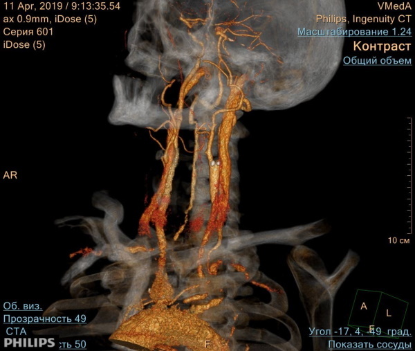 Arterier i hode og nakke. Anatomi, diagram med beskrivelse