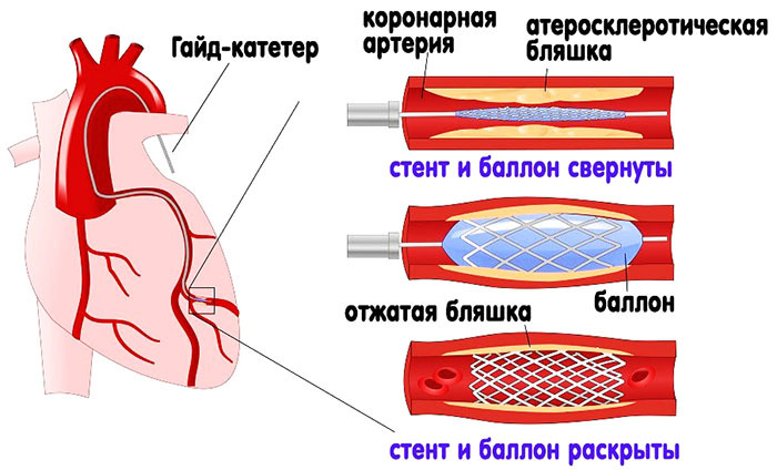 Atherosclerosis of the vessels of the heart. Symptoms and treatment in the elderly, causes