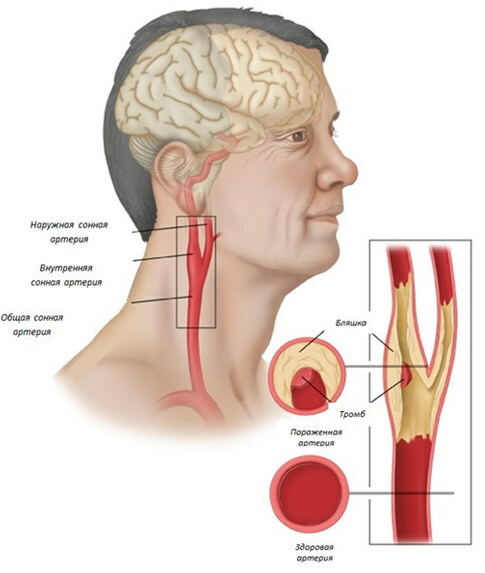 A BCA (brachiocephalic artériák) nem szűkületes ateroszklerózisa