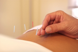 Akupunktur mit Rückenschmerzen