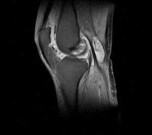 Röntgenfoto van de knie