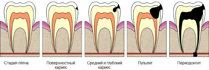 How to cure caries without a dentist in a child, teenager