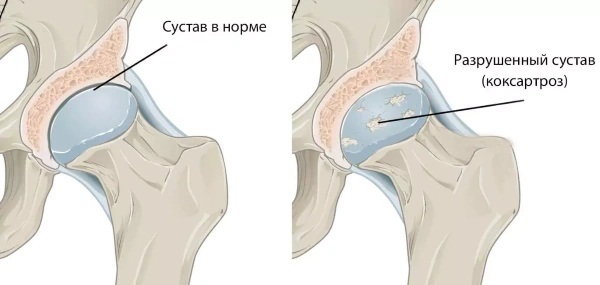 Coxarthrosis of the 2nd degree of the hip joint. Treatment, folk remedies, injections, drugs, surgery