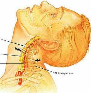Diagnoza cervikalija: simptomi in zdravljenje bolečin v vratu
