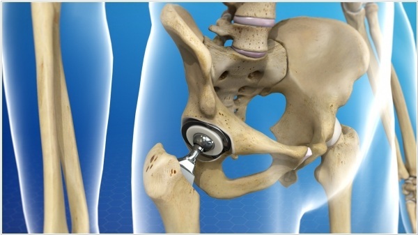 Hip joint endoprosthesis. Price, service life, photo, x-ray