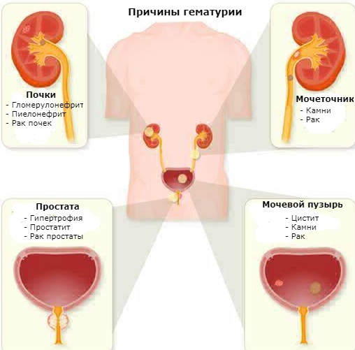 Unchanged red blood cells in the urine. What does it mean, elevated, reasons, norm