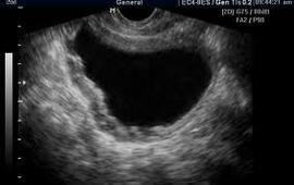 Pūslės ultragarsas