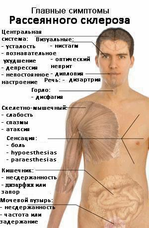 symptomen van sclerose