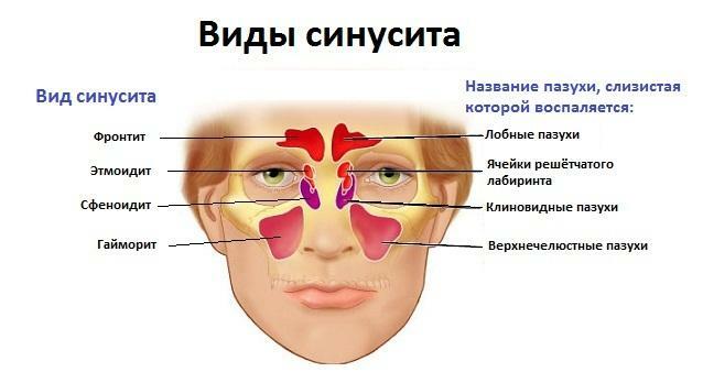 Symptoms of sinusitis in adults