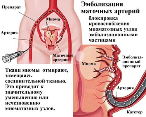 Nepravidelný menštruačný cyklus. Dôvody u mladistvých, po pôrode, ako sa liečiť, otehotnieť