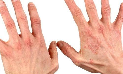 Behandlung von Ekzemen in den Händen