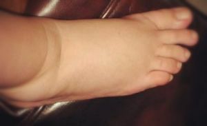 arthrose af foden
