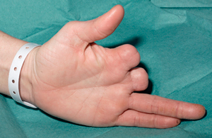 amputación de dedos