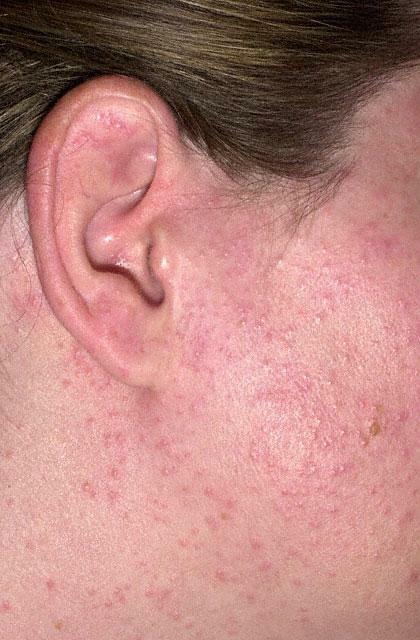 In geval van een allergische reactie kan huiduitslag optreden