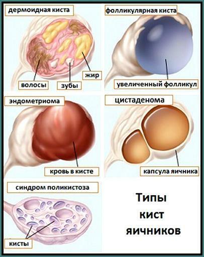 Types of Ovarian Cysts