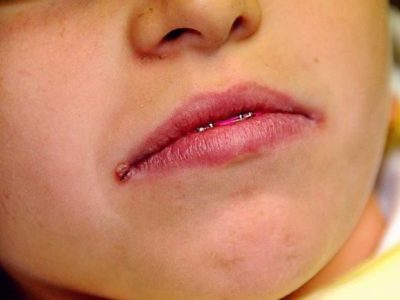Zaeda u dítěte v koutcích úst: příčiny a léčba