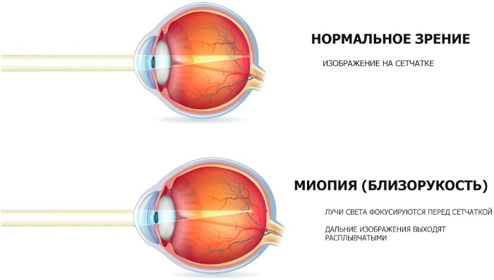 Ochelari perifocali pentru copii pentru a opri miopia. Prețuri, cercetare