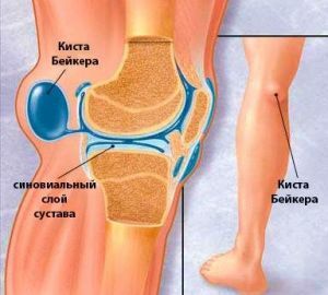 Tætning på indersiden af ​​knæet