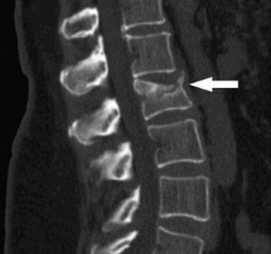 frattura della colonna vertebrale su raggi X.