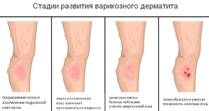 Dermatitis på benene. Behandling, salver og cremer til et barn, en voksen