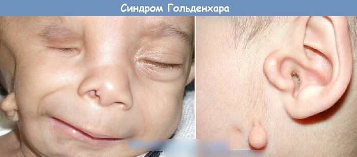 Wide nose bridge in a child. What is it, reasons