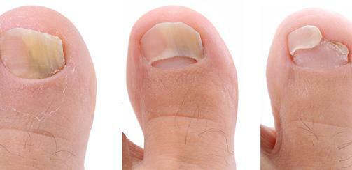 Stages of onychomycosis