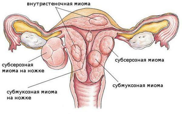Arten von Uterusmyomen