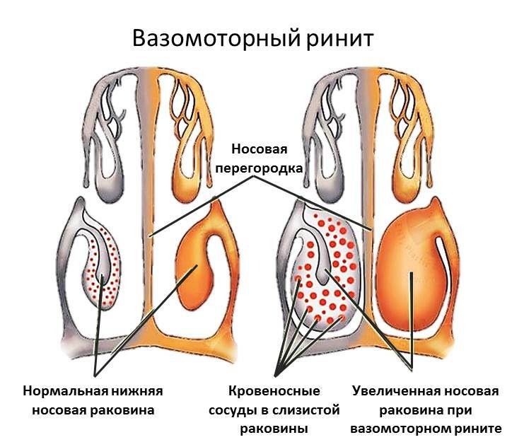 Schéma de la rhinite vasomotrice
