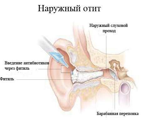 Externé zápal stredného ucha: príznaky a liečba