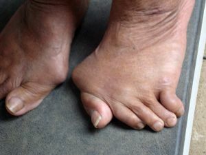 Osteoarthritis of the foot joints