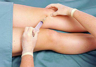 Behandeling van synovitis van het kniegewricht