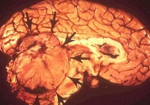 meduloblastómový cerebelum