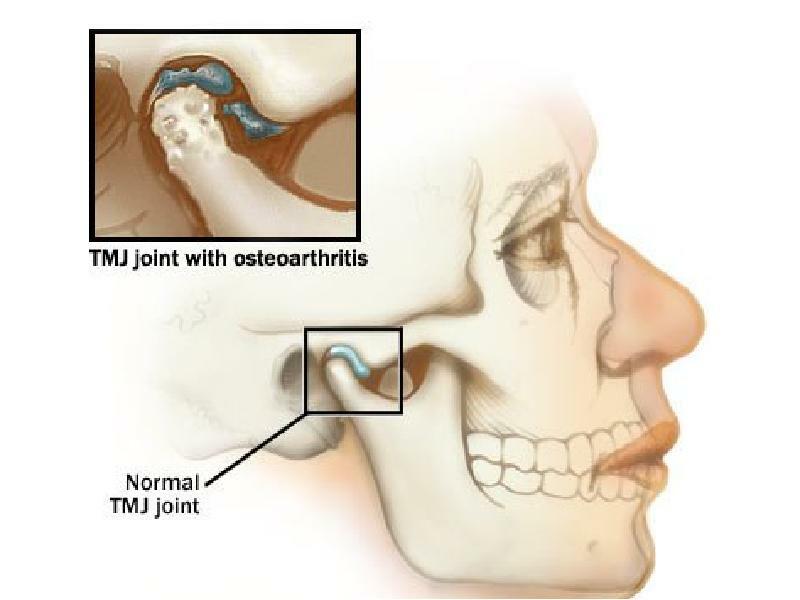 Osteoartrita articulației temporomandibulare este o boală cronică