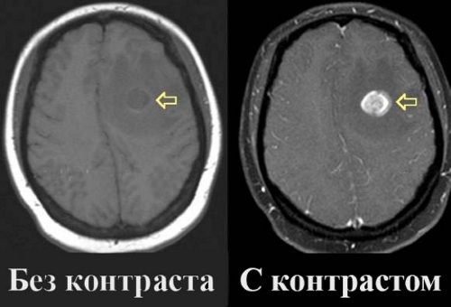 MRI of the head. What shows how they do it, what is the difference with and without contrast, preparation, indications, contraindications